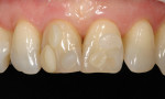 Figure  13  CLINICAL EXAMPLES Prior to tooth preparation, shade selection was completed to determine the sequence of color layering.