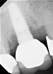 Fig 20. The 8-month postoperative radiograph showed bone graft material remaining in the grafted site.