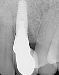 Fig 25. The 14-month postoperative radiograph showed osseous fill of the infrabony defect.