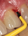 Fig 21. Case 3, 9 mm pocketing and BOP, distal of maxillary left cuspid.