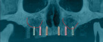 Fig 1. Enlargement of the maxillary sinus frequently requires augmentation of the sinus to permit implant placement in the posterior when implants are placed in an axial direction (parallel to other implants in the arch).