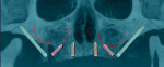 Fig 3. Use of zygomatic implants allows the maxillary sinus to be bypassed while the prosthetic platform may be positioned more distally, allowing a full complement of teeth to be placed to restore the full arch.