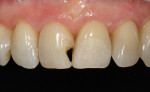 Figure  14  CLINICAL EXAMPLES Minimally invasive tooth preparation was done to create invisible margins.