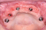 Fig 9. Emergence of the prosthetic platform of the case shown in Fig 7 falls at the midline of the crest (ZAGA 0 classification), allowing
screw-access emergence in the prosthesis to be in the occlusal surface.