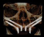 Fig 12. CBCT of the case shown in Fig 11 demonstrating the position of the four zygomatic implants.