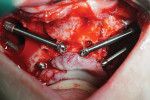 Fig 11. Quad case using zygomatic implants. Three implants ZAGA 4 (top right side of maxilla and both on left side) and one implant ZAGA 0 (bottom right side of maxilla) were used to restore a severely atrophic maxilla.