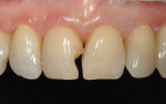 Figure  15  CLINICAL EXAMPLES Adhesive bonding prior to composite resin placement.