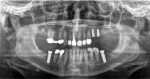 Fig 17. Sinus enlargement in the left posterior maxilla limited implant placement distal to the existing implants at the premolar sites, and osseous grafting would be required for implant placement.