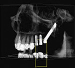 Fig 19. A zygomatic implant was instead placed into the posterior left, allowing the maxillary sinus to be avoided and the need to augment that region for standard implant placement to be averted. This enables a shortened treatment
time prior to implant loading and reduces costs as grafting of the sinus is unnecessary.