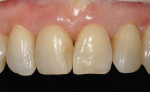 Figure  16  CLINICAL EXAMPLES  An internal, opacious dentin shade was sculpted internally to block out shine-through of light.