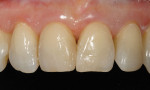 Figure  17  CLINICAL EXAMPLES An enamel shade was sculpted over the opacious dentin for the correct optical tooth appearance.