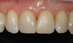 Figure  18  CLINICAL EXAMPLES To create an optimal depth of shade, a neutral translucency was placed over the surface as a final layer.
