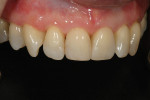 Figure  22  CLINICAL EXAMPLES With proper material selection, tooth preparation, color layering, and finishing/polishing technique, minimally invasive dentistry can be achieved predictably and consistently.