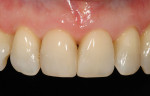 Figure  23  CLINICAL EXAMPLES With proper material selection, tooth preparation, color layering, and finishing/polishing technique, minimally invasive dentistry can be achieved predictably and consistently.