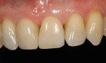 Figure  24  CLINICAL EXAMPLES With proper material selection, tooth preparation, color layering, and finishing/polishing technique, minimally invasive dentistry can be achieved predictably and consistently.