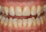 Figure  25  CLINICAL EXAMPLES Progress in dental materials and technique allows the dentist to recreate the beauty of natural dentition with minimal intervention.
