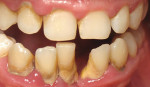 Figure 11  Pretreatment frontal view of teeth Nos. 23, 25, and 26.