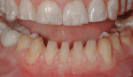 Facial view of prepared mandibular arch.