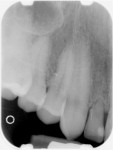 Preoperative radiograph of the deciduous tooth D.