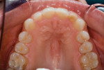 Preoperative, 1:2 occlusal view.