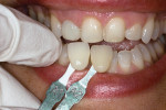 Shade guide photograph of prepared teeth with the provisional implant/crown in place.