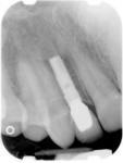 Postoperative radiograph of implant, abutment, and crown.