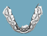 Dual arch scan captured using intraoral scanner.