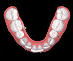 Closed contact between teeth Nos. 30 and 29 at week 13.