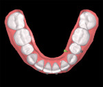 Closed contact between teeth Nos. 22 and 20 at week 25.