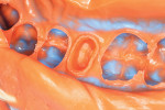 Detailed view of the lingual and mesial margins.