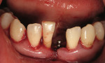 Figure 12  Immediately posttreatment, occlusal view of area surrounding teeth Nos. 23, 25, and 26. LANAP, placement of a mini implant in site No. 24, and a frenectomy were completed.