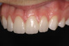 Figure 9  Extraction of teeth Nos. 29 and 31 with immediate implants (Straumann USA, Waltham, MA) placed into the site.