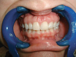 Figure  13  CLINICAL PRESENTATION The restoration at 3 years. Note the filling in of the distal papillae and the maintenance of the facial-gingival margin.