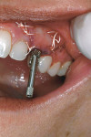 Figure  15  CLINICAL PRESENTATION The fabrication of a screw-retained provisional restoration immediately after surgery.