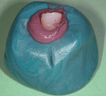 Figure  18  CLINICAL PRESENTATION Fabrication of the open-tray custom impression coping.