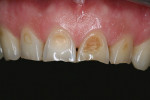 Figure  2  CLINICAL EXAMPLE  Close-up preoperative view of the patient“s dentition.