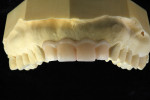 Figure  4  CLINICAL EXAMPLE  The diagnostic wax-up shows the desired length and form of the planned crowns.