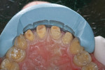 Figure  6  CLINICAL EXAMPLE   A silicone putty index of the diagnostic wax-up was used to guide tooth preparation and ensure adequate reduction.