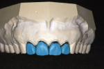 Figure  9  CLINICAL EXAMPLE   The crowns were waxed on the master cast.