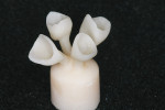 Figure  11  CLINICAL EXAMPLE  The completed wax-ups were sprued, invested, burned out, and pressed using the IPS e.max LT A2 ingot.