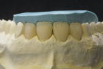 Figure  14  CLINICAL EXAMPLE  After the first bake, the crowns were placed on the master cast with the lingual index to verify length.