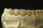Figure  17  CLINICAL EXAMPLE  Final glazing at 725° C and hand polishing brought the restorations to their lifelike luster.