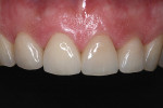 Figure  18  CLINICAL EXAMPLE   A final try-in of the crowns verified fit, occlusion, and esthetics.