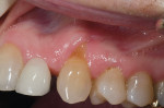 Figure  1  SHADE MATCHING Initial appearance of the noncarious cervical lesion in the esthetic zone.