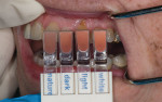 Figure  2  SHADE MATCHING Shade matching of the gingival tissue, prior to injection of local anesthesia, using the provided shade guide.