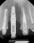 Fig 4. Preoperative radiograph showed the bony defects adjacent to teeth Nos. 7 and 9.