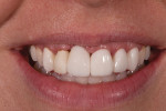 Fig 2. Close-up view showed the soft-tissue defect visible in the area of teeth Nos. 7 through 9.
