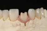 Fig 11. Pink porcelain was housed on the abutment to facilitate cement removal and healthy tissue.