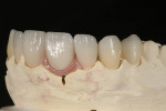 Fig 12. The porcelain crown in place on the model.