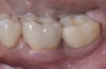Fig 1. Pretreatment clinical view of mandibular left first molar.